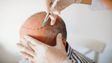 FUE hair transplant