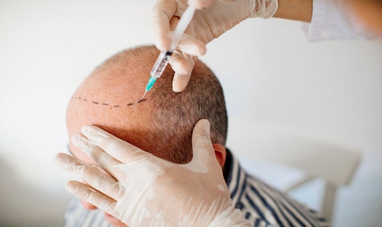 FUE hair transplant