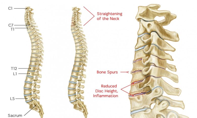 spinal fracture