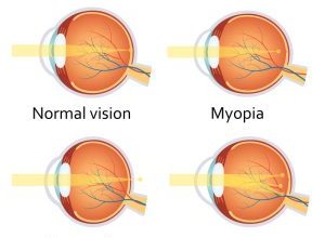 Refractive Errors Image