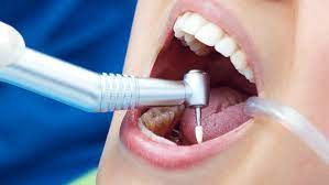 root canal specialist Toronto