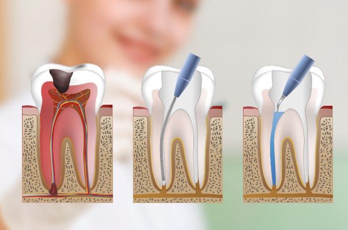 root canal in London Ontario